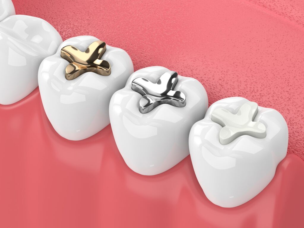 Cavity Fillings