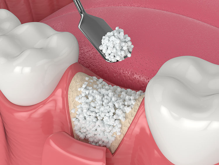 Dental Bone Grafting