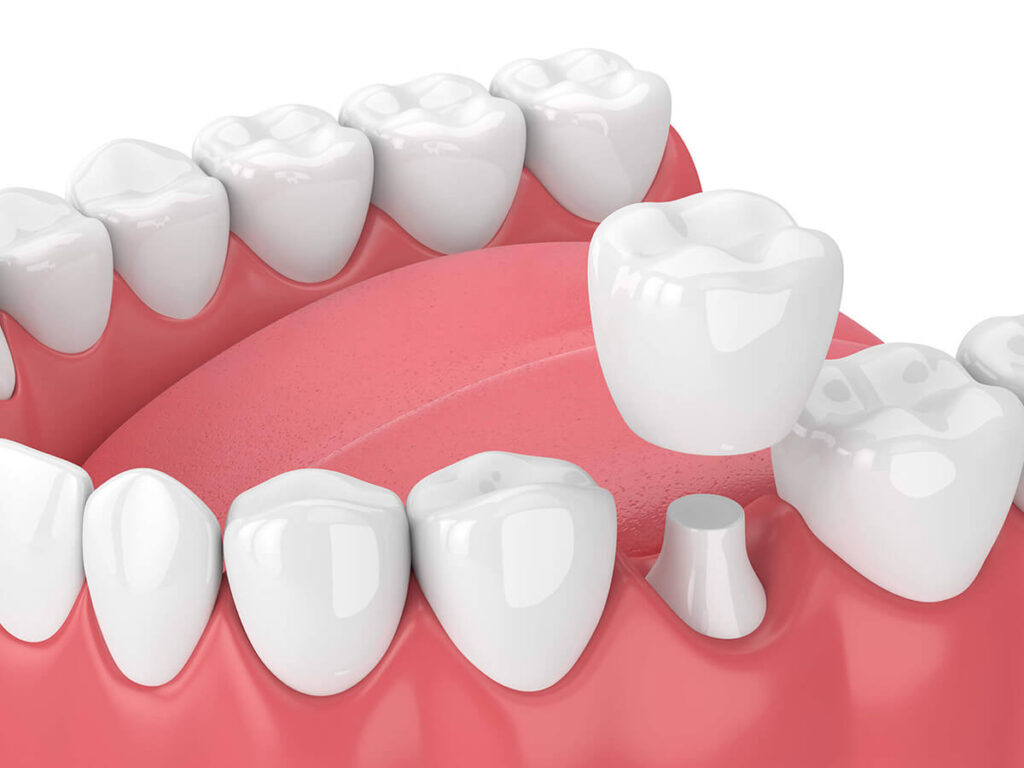 Dental Crowns & Bridges