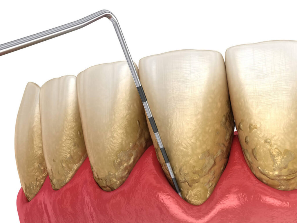 Gum (Periodontal) Disease Treatment